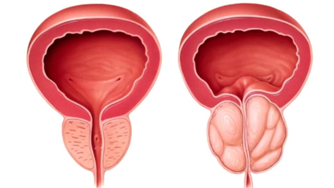 healthy and sick prostate