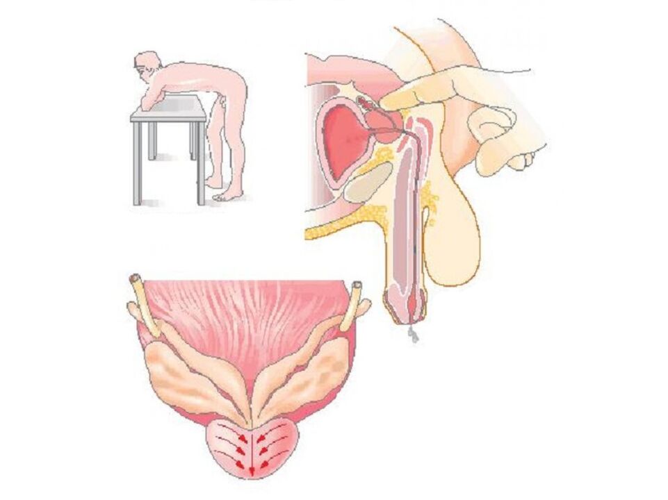 Prostate massage technique performed by a doctor to perform an analysis of the secretion. 